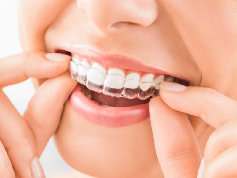 Close-up of hands placing a clear dental aligner over teeth