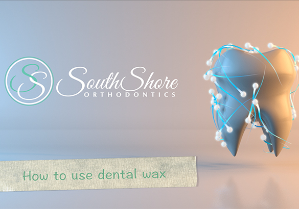 Traditional Braces - Riverview, FL - SouthShore Orthodontics