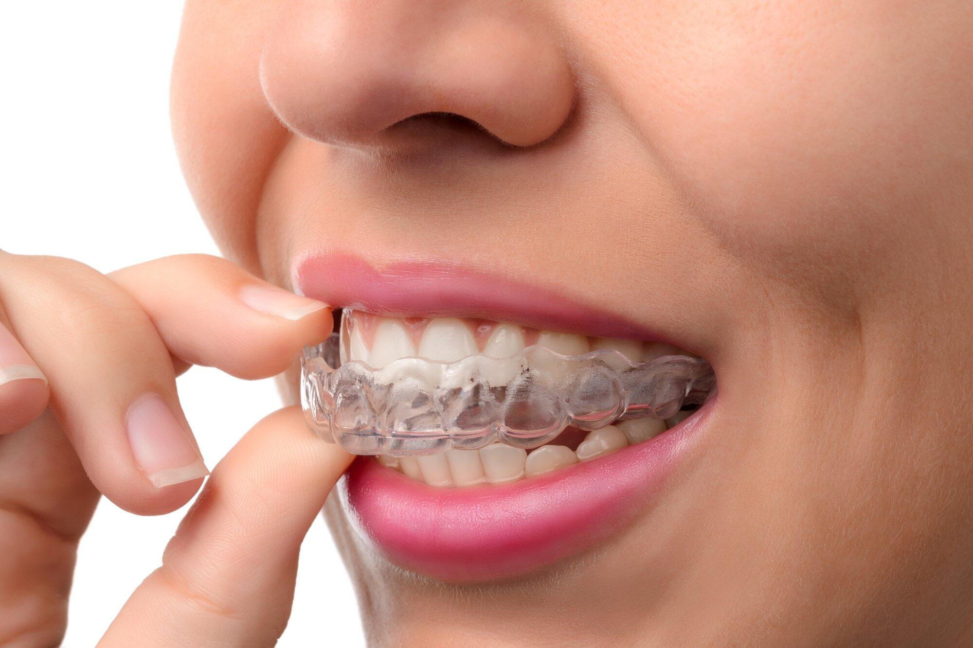 Chagrin Falls Invisalign